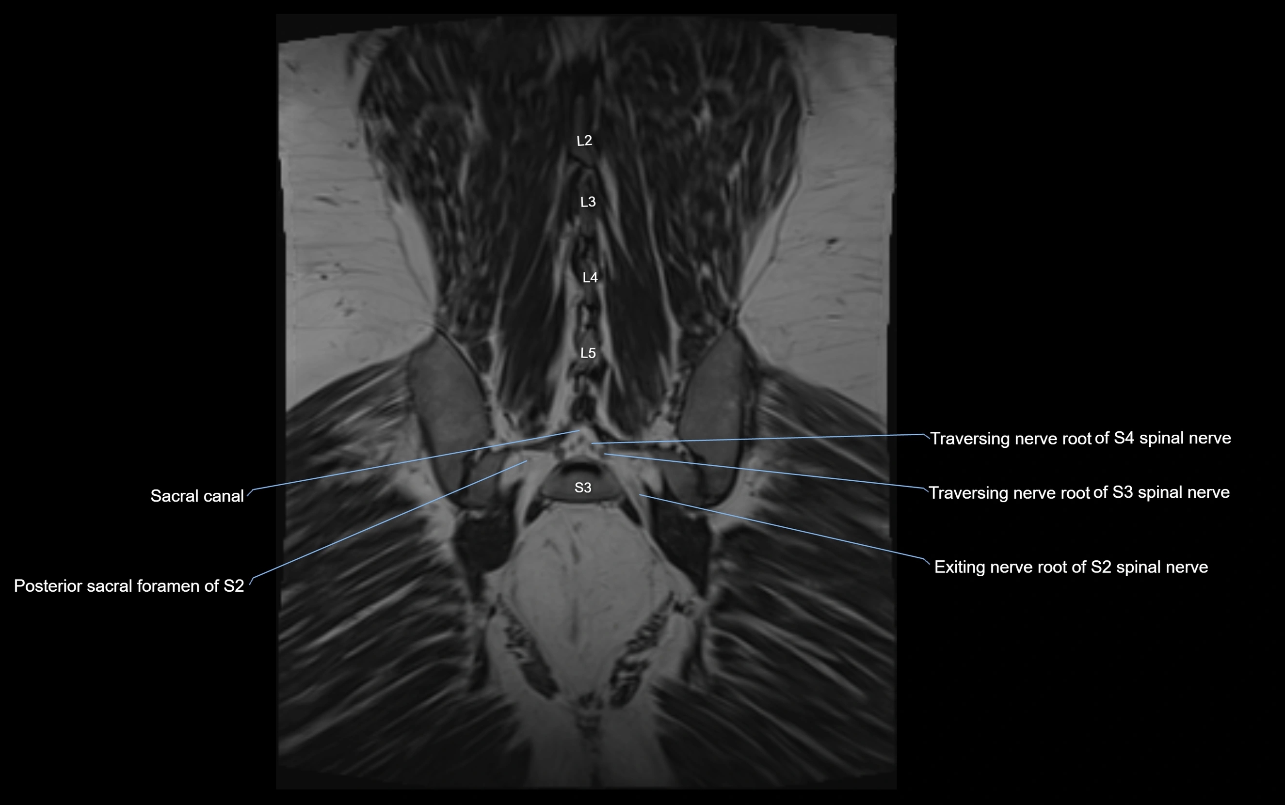 MR lumbosacral plexus cross sectional anatomy 3T  radiology  image-img-09001-00067.webp
